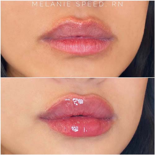 Lip Augmentation Before & After Photos by Flawless Medspa in Las Vegas NV