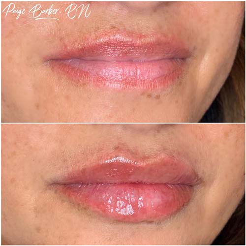 Lip Augmentation Before & After Photos by Flawless Medspa in Las Vegas NV