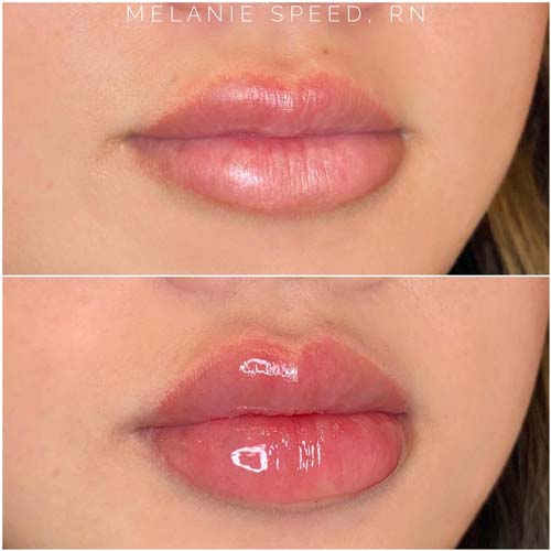 Lip Augmentation Before & After Photos by Flawless Medspa in Las Vegas NV