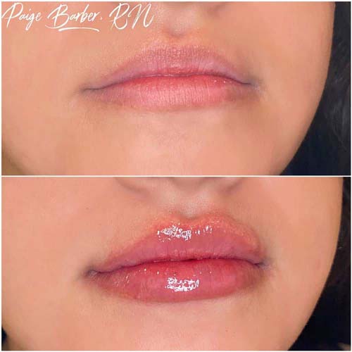 Lip Augmentation Before & After Photos by Flawless Medspa in Las Vegas NV