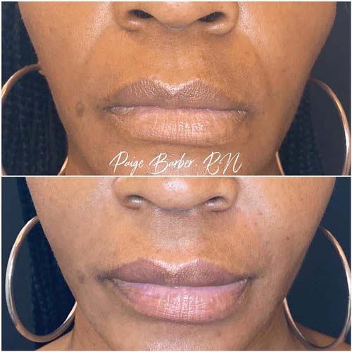 Lip Augmentation Before & After Photos by Flawless Medspa in Las Vegas NV