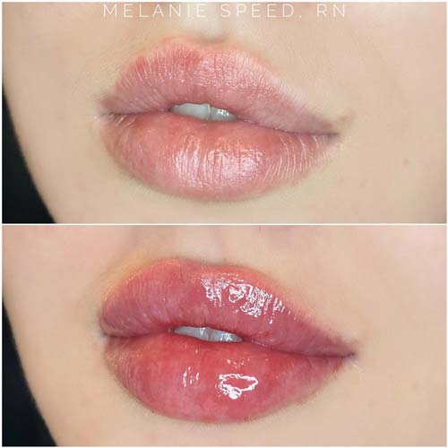 Lip Augmentation Before & After Photos by Flawless Medspa in Las Vegas NV