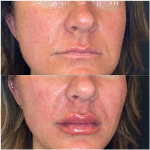 Lip Augmentation by Flawless Medspa Lip Augmentation by Flawless Medspa