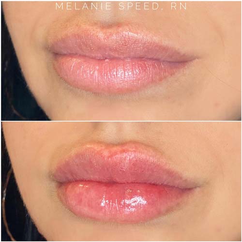 Lip Augmentation Before & After Photos by Flawless Medspa in Las Vegas NV