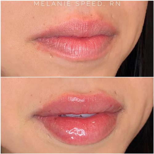 Lip Augmentation Before & After Photos by Flawless Medspa in Las Vegas NV