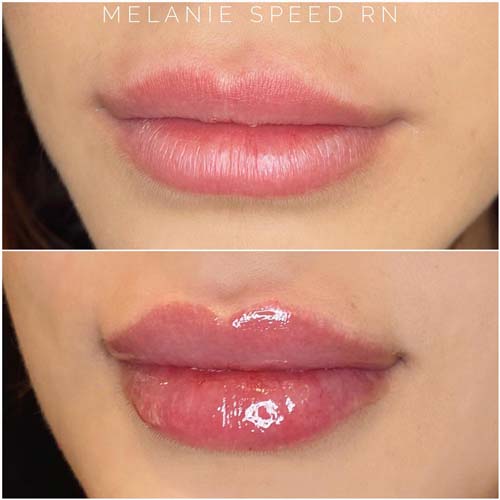 Lip Augmentation Before & After Photos by Flawless Medspa in Las Vegas NV