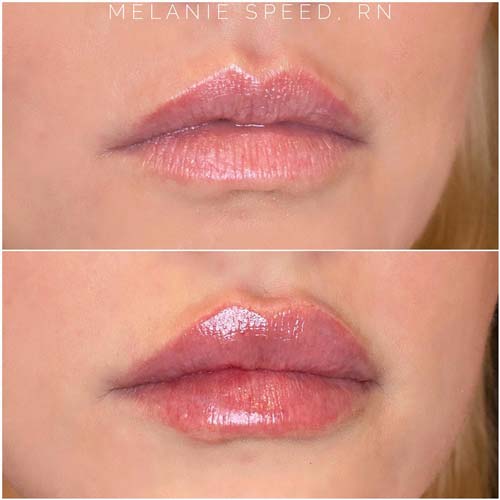 Lip Augmentation Before & After Photos by Flawless Medspa in Las Vegas NV