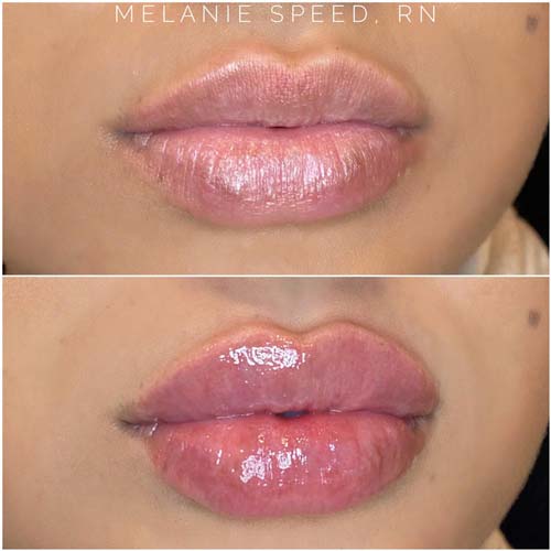 Lip Augmentation Before & After Photos by Flawless Medspa in Las Vegas NV