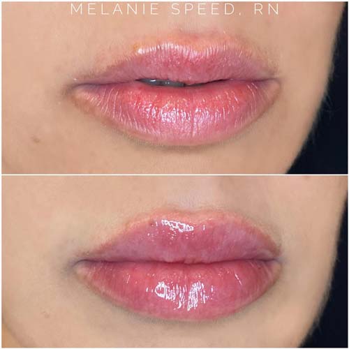 Lip Augmentation Before & After Photos by Flawless Medspa in Las Vegas NV