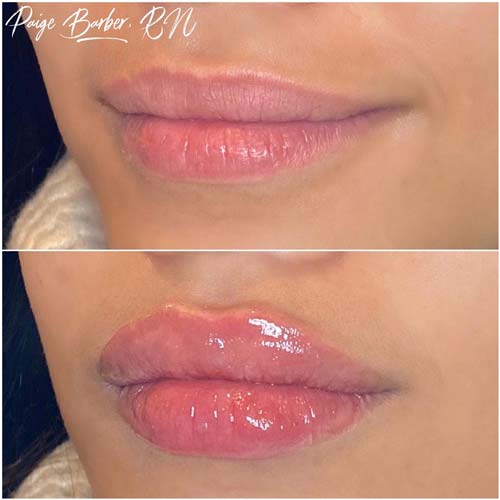 Lip Augmentation Before & After Photos by Flawless Medspa in Las Vegas NV