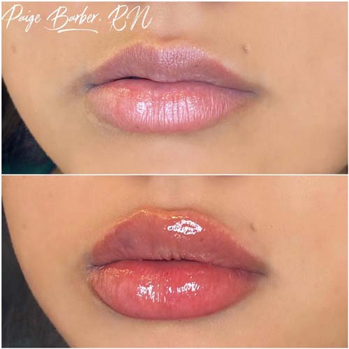 Lip Augmentation Before & After Photos by Flawless Medspa in Las Vegas NV