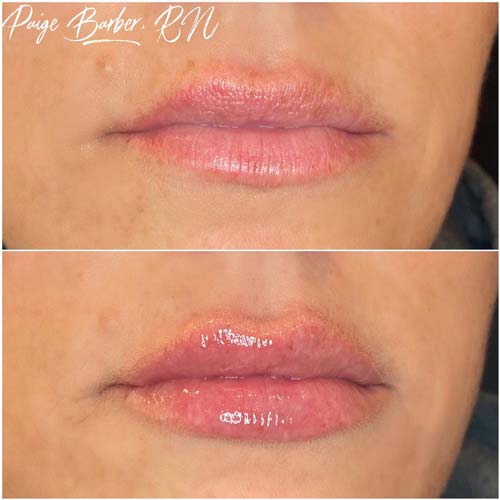 Lip Augmentation Before & After Photos by Flawless Medspa in Las Vegas NV