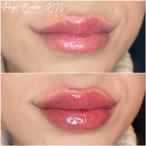 Lip Augmentation Before & After Photos by Flawless Medspa in Las Vegas NV