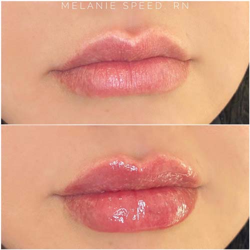 Lip Augmentation Before & After Photos by Flawless Medspa in Las Vegas NV