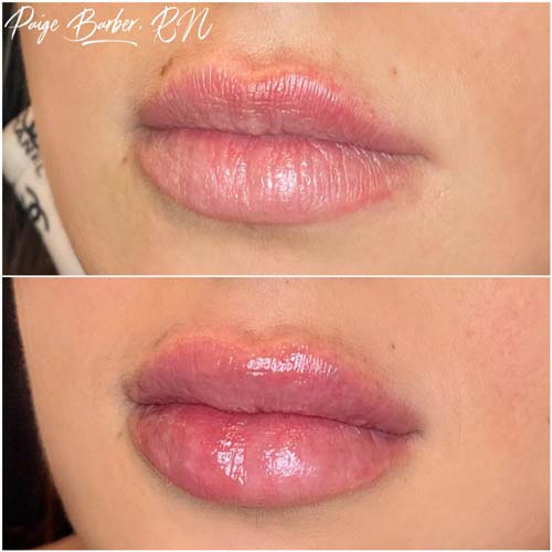 Lip Augmentation Before & After Photos by Flawless Medspa in Las Vegas NV