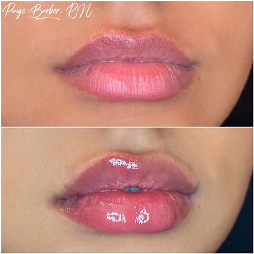 Lip Augmentation Before & After Photos by Flawless Medspa in Las Vegas NV