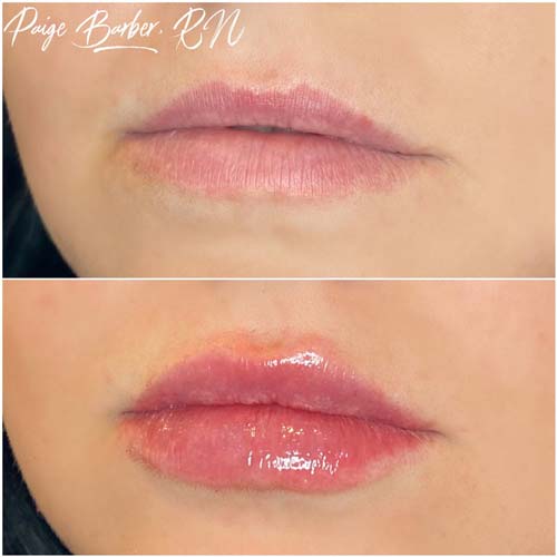 Lip Augmentation Before & After Photos by Flawless Medspa in Las Vegas NV