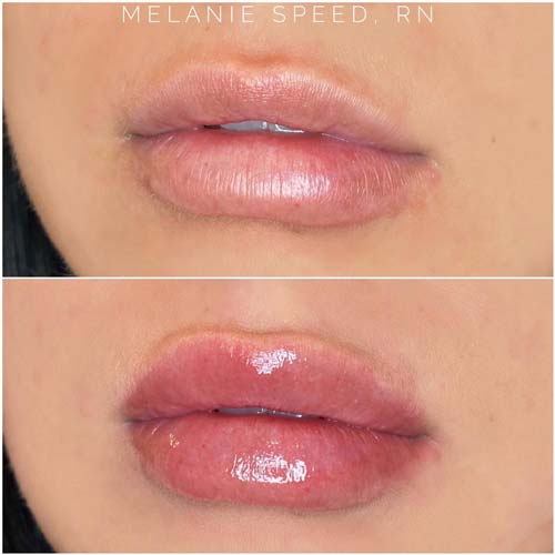 Lip Augmentation Before & After Photos by Flawless Medspa in Las Vegas NV