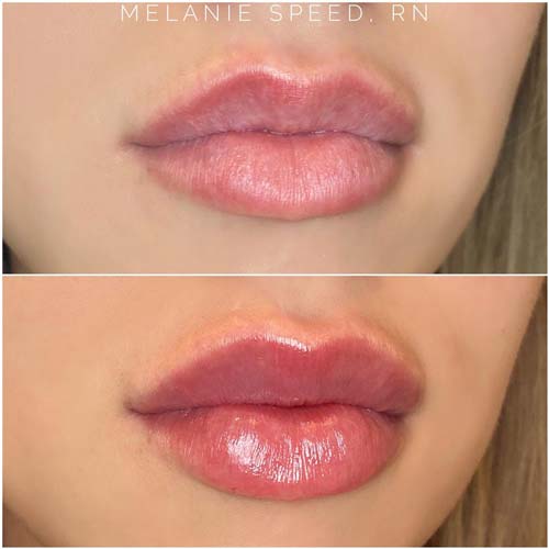 Lip Augmentation Before & After Photos by Flawless Medspa in Las Vegas NV