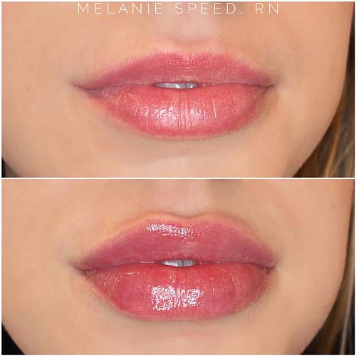 Lip Augmentation Before & After Photos by Flawless Medspa in Las Vegas NV