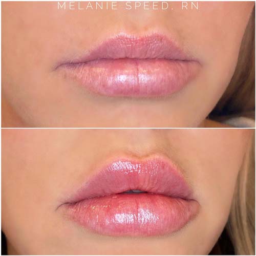 Lip Augmentation Before & After Photos by Flawless Medspa in Las Vegas NV