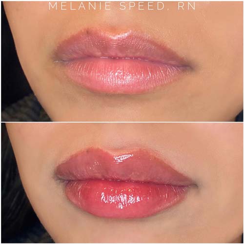 Lip Augmentation Before & After Photos by Flawless Medspa in Las Vegas NV