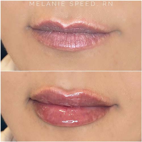 Lip Augmentation Before & After Photos by Flawless Medspa in Las Vegas NV