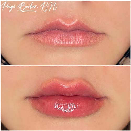 Lip Augmentation Before & After Photos by Flawless Medspa in Las Vegas NV