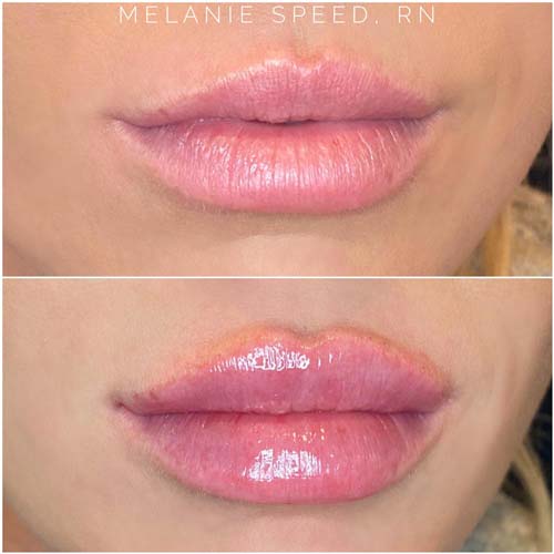 Lip Augmentation Before & After Photos by Flawless Medspa in Las Vegas NV