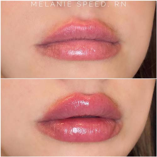 Lip Augmentation Before & After Photos by Flawless Medspa in Las Vegas NV