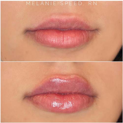 Lip Augmentation Before & After Photos by Flawless Medspa in Las Vegas NV