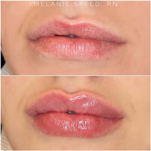 Lip Augmentation Before & After Photos by Flawless Medspa in Las Vegas NV