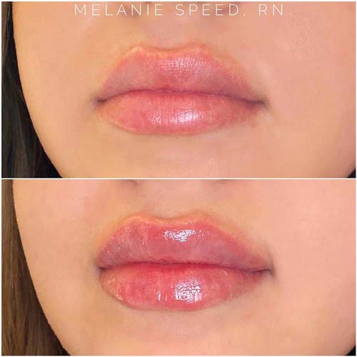 Lip Augmentation Before & After Photos by Flawless Medspa in Las Vegas NV