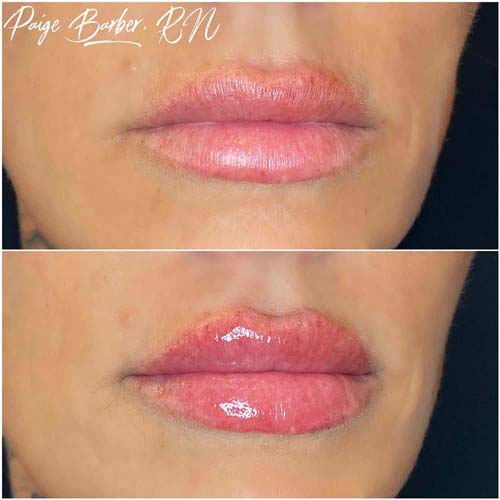 Lip Augmentation Before & After Photos by Flawless Medspa in Las Vegas NV