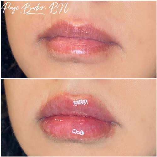 Lip Augmentation Before & After Photos by Flawless Medspa in Las Vegas NV