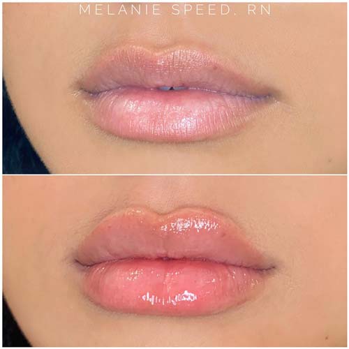 Lip Augmentation Before & After Photos by Flawless Medspa in Las Vegas NV