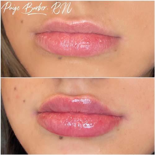 Lip Augmentation Before & After Photos by Flawless Medspa in Las Vegas NV