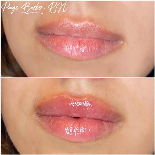 Lip Augmentation Before & After Photos by Flawless Medspa in Las Vegas NV