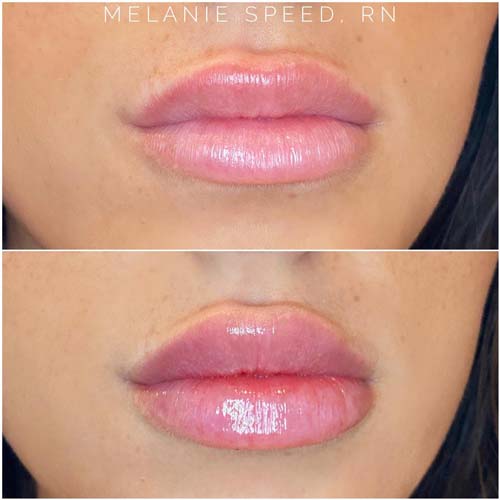 Lip Augmentation Before & After Photos by Flawless Medspa in Las Vegas NV