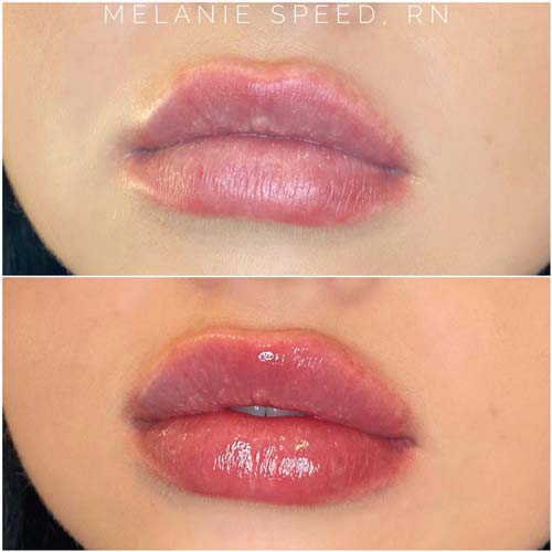 Lip Augmentation Before & After Photos by Flawless Medspa in Las Vegas NV