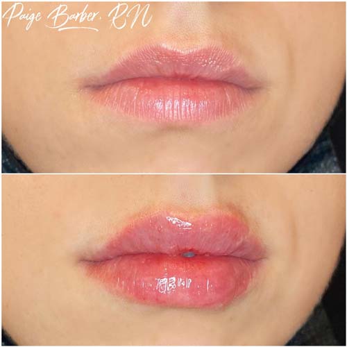 Lip Augmentation Before & After Photos by Flawless Medspa in Las Vegas NV