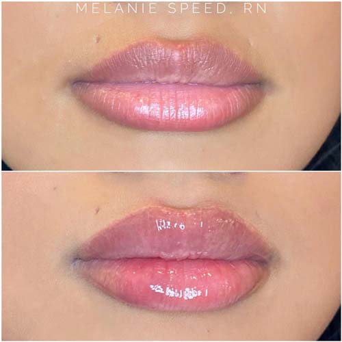 Lip Augmentation Before & After Photos by Flawless Medspa in Las Vegas NV