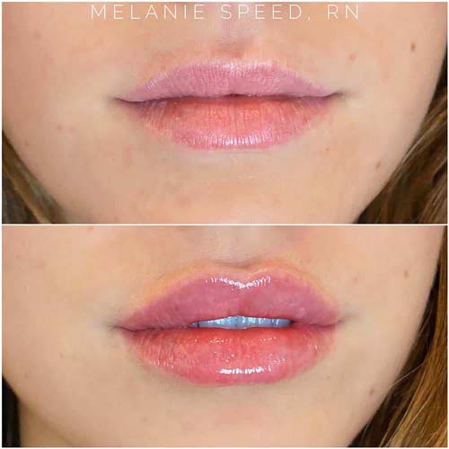 Lip Augmentation Before & After Photos by Flawless Medspa in Las Vegas NV