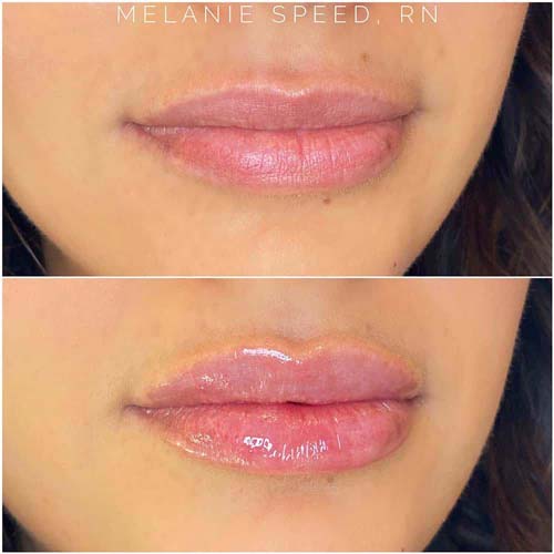 Lip Augmentation Before & After Photos by Flawless Medspa in Las Vegas NV