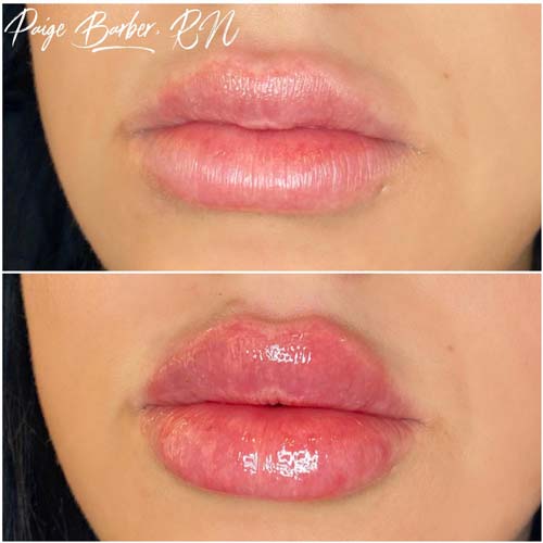 Lip Augmentation Before & After Photos by Flawless Medspa in Las Vegas NV