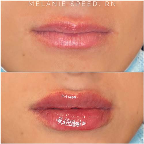 Lip Augmentation Before & After Photos by Flawless Medspa in Las Vegas NV