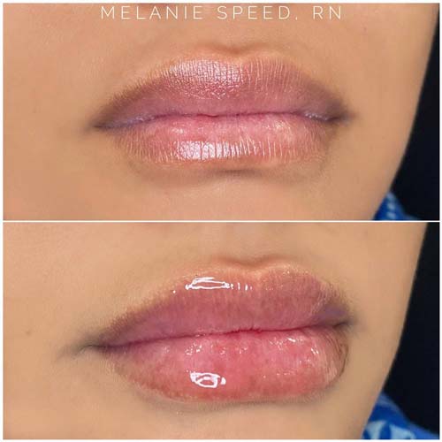 Lip Augmentation Before & After Photos by Flawless Medspa in Las Vegas NV