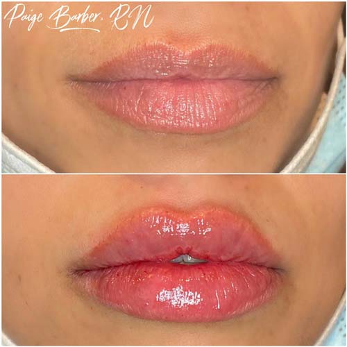 Lip Augmentation Before & After Photos by Flawless Medspa in Las Vegas NV