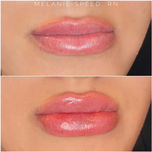 Lip Augmentation Before & After Photos by Flawless Medspa in Las Vegas NV