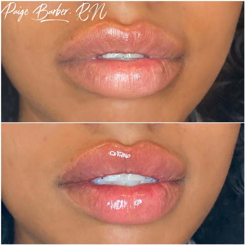 Lip Augmentation Before & After Photos by Flawless Medspa in Las Vegas NV